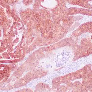 Immunohistochemistry (IHC) : Human colon adenocarcinoma stained with EP-CAM antibody using peroxidase-conjugate and DAB chromogen. Note the membranous staining of tumor cells.