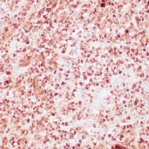 Human pituitary stained with anti-ACTH monoclonal antibody using peroxidase-conjugate and DAB chromogen. Note the cytoplasmic/nuclear staining of ACTH secreting cells.