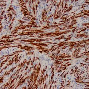Immunohistochemistry (IHC) : Human uterus stained with anti-SMA antibody using peroxidase-conjugate and DAB chromogen. Note the cytoplasmic staining of smooth muscle.