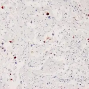 Immunohistochemistry (IHC) : Human lung stained with anti-Adenovirus antibody using peroxidase-conjugate and DAB chromogen. Note the nuclear staining of adenovirus infected pneumocytes .