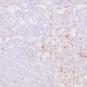 Immunohistochemistry (IHC) : Human yolk sac tumor stained with anti-AFP polyclonal antibody using peroxidase-conjugate and DAB chromogen. Note cytoplasmic staining of tumor cells..