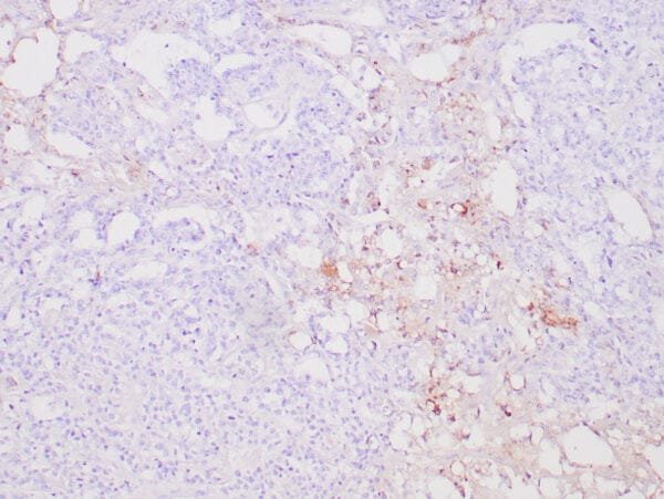 Immunohistochemistry (IHC) : Human yolk sac tumor stained with anti-AFP polyclonal antibody using peroxidase-conjugate and DAB chromogen. Note cytoplasmic staining of tumor cells..