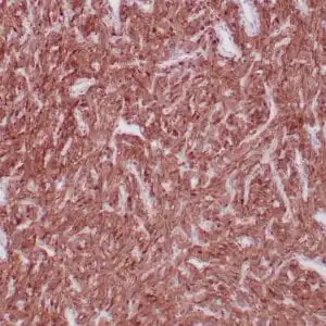 Immunohistochemistry (IHC) : Formalin-fixed, paraffin-embedded human solitary fibrous tumor stained with anti-ALDH1A1 monoclonal antibody using peroxidase-conjugate and DAB chromogen. Note the cytoplasmic/nuclear staining of tumor cells