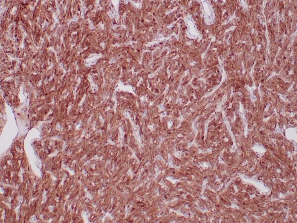 Immunohistochemistry (IHC) : Formalin-fixed, paraffin-embedded human solitary fibrous tumor stained with anti-ALDH1A1 monoclonal antibody using peroxidase-conjugate and DAB chromogen. Note the cytoplasmic/nuclear staining of tumor cells