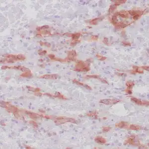 Immunohistochemistry (IHC) : Human lung adenocarcinoma stained with anti-ALK-1 antibody using peroxidase-conjugate and DAB chromogen. Note cytoplasmic stain of adenocarcinoma cells.