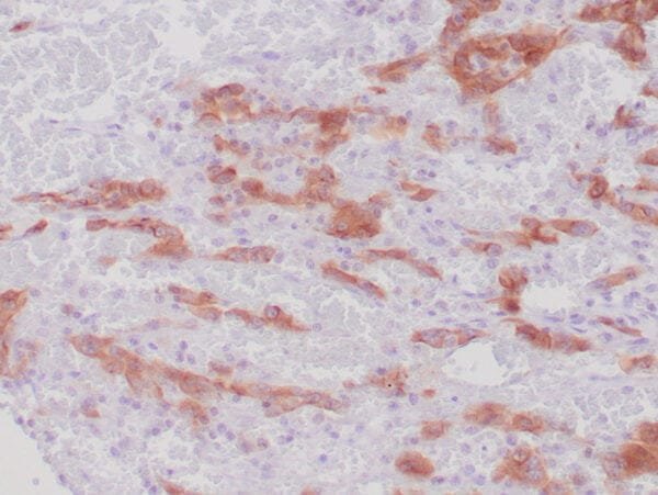 Immunohistochemistry (IHC) : Human lung adenocarcinoma stained with anti-ALK-1 antibody using peroxidase-conjugate and DAB chromogen. Note cytoplasmic stain of adenocarcinoma cells.