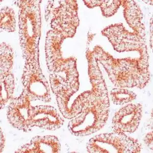 Immunohistochemistry (IHC) : Human prostate carcinoma stained anti-AMACR antibody using peroxidase-conjugate and DAB chromogen. Note cytoplasmic and luminal circumferential staining of carcinoma glands.