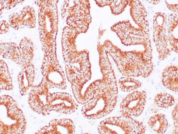 Immunohistochemistry (IHC) : Human prostate carcinoma stained anti-AMACR antibody using peroxidase-conjugate and DAB chromogen. Note cytoplasmic and luminal circumferential staining of carcinoma glands.