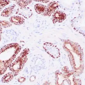 Immunohistochemistry (IHC) : Human prostate carcinoma stained anti-AMACR and anti-p63 antibodies using peroxidase-conjugate and DAB chromogen. Note cytoplasmic and luminal circumferential staining of carcinoma glands with AMACR and basal cell nuclear staining with p63.