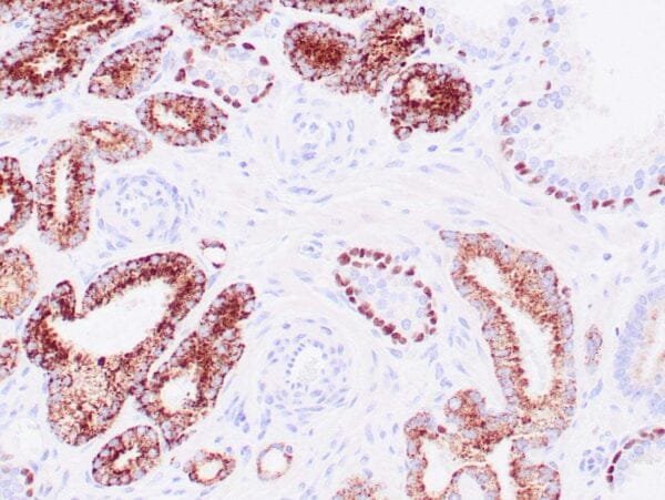 Immunohistochemistry (IHC) : Human prostate carcinoma stained anti-AMACR and anti-p63 antibodies using peroxidase-conjugate and DAB chromogen. Note cytoplasmic and luminal circumferential staining of carcinoma glands with AMACR and basal cell nuclear staining with p63.