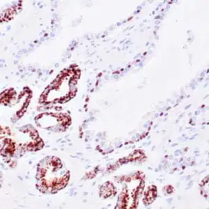 Immunohistochemistry (IHC) : Human prostate carcinoma stained anti-AMACR and anti-p63 antibodies using peroxidase-conjugate and DAB chromogen. Note cytoplasmic and luminal circumferential staining of carcinoma glands with AMACR and basal cell nuclear staining with p63.