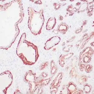 Immunohistochemistry (IHC) : Human prostate carcinoma stained anti-AMACR, anti-p63 and anti-HMW CK 34βE12 antibodies using peroxidase-conjugate and DAB chromogens. Note cytoplasmic and luminal circumferential staining of carcinoma glands with AMACR and basal cell staining with p63 and HMW CK 34βE12.