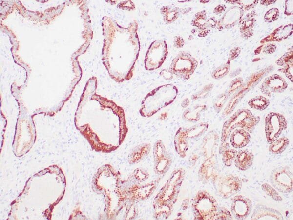 Immunohistochemistry (IHC) : Human prostate carcinoma stained anti-AMACR, anti-p63 and anti-HMW CK 34βE12 antibodies using peroxidase-conjugate and DAB chromogens. Note cytoplasmic and luminal circumferential staining of carcinoma glands with AMACR and basal cell staining with p63 and HMW CK 34βE12.