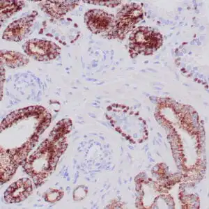 Immunohistochemistry (IHC) : Human prostate carcinoma stained anti-AMACR, anti-p63 and anti-HMW CK 34βE12 antibodies using peroxidase-conjugate and DAB chromogens. Note cytoplasmic and luminal circumferential staining of carcinoma glands with AMACR and basal cell staining with p63 and HMW CK 34βE12.