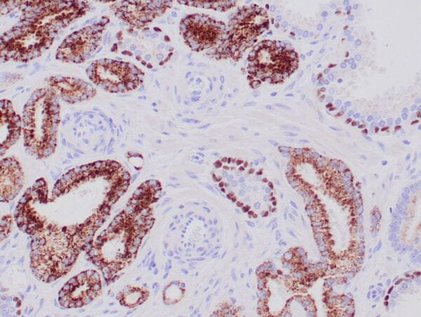 Immunohistochemistry (IHC) : Human prostate carcinoma stained anti-AMACR, anti-p63 and anti-HMW CK 34βE12 antibodies using peroxidase-conjugate and DAB chromogens. Note cytoplasmic and luminal circumferential staining of carcinoma glands with AMACR and basal cell staining with p63 and HMW CK 34βE12.