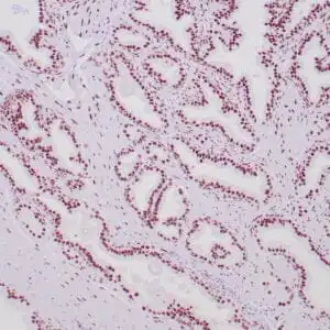Immunohistochemistry (IHC) : human prostate tissue stained with anti-AR receptor using peroxidase conjugate and DAB chromogen. Note nuclear staining of glandular cells