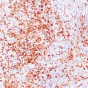 Immunohistochemistry (IHC) : Human lymph node involved by hairy cell leukemia stained with anti-Annexin A1 antibody using peroxidase-conjugate and DAB chromogen. Note nuclear/cytoplasmic staining of tumor cells.