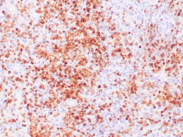 Immunohistochemistry (IHC) : Human lymph node involved by hairy cell leukemia stained with anti-Annexin A1 antibody using peroxidase-conjugate and DAB chromogen. Note nuclear/cytoplasmic staining of tumor cells.