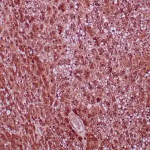 Immunohistochemistry (IHC) : Formalin-fixed, paraffin-embedded human hepatic adenoma stained with anti-arginase-1 polyclonal antibody using peroxidase-conjugate and DAB chromogen. Note cytoplasmic and nuclear staining of hepatocytes.
