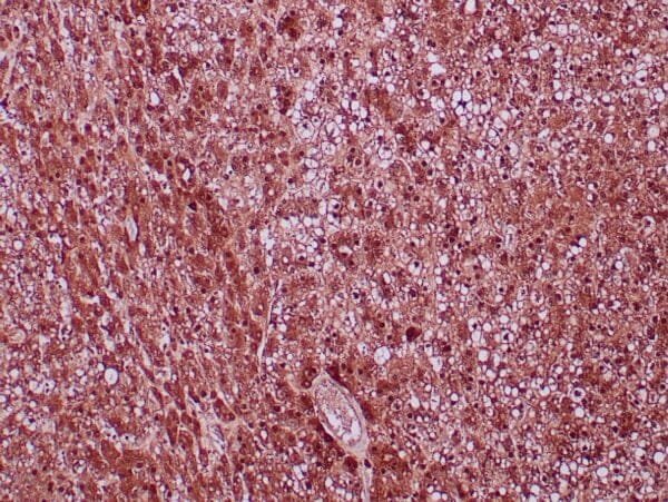 Immunohistochemistry (IHC) : Formalin-fixed, paraffin-embedded human hepatic adenoma stained with anti-arginase-1 polyclonal antibody using peroxidase-conjugate and DAB chromogen. Note cytoplasmic and nuclear staining of hepatocytes.