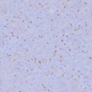 Immunohistochemistry (IHC) : Formalin-fixed, paraffin-embedded malignant mesothelioma stained with anti-BAP1 antibody using peroxidase-conjugate and DAB chromogen. Note loss of nuclear stain in tumor cells whereas the background cells are positive