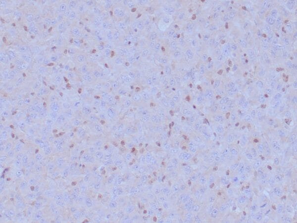 Immunohistochemistry (IHC) : Formalin-fixed, paraffin-embedded malignant mesothelioma stained with anti-BAP1 antibody using peroxidase-conjugate and DAB chromogen. Note loss of nuclear stain in tumor cells whereas the background cells are positive