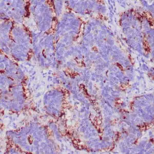 Immunohistochemistry (IHC) : Human breast adenocarcinoma stained with anti-BCA-255 antibody using peroxidase-conjugate and DAB chromogen. Note the cytoplasmic staining of tumor cells.