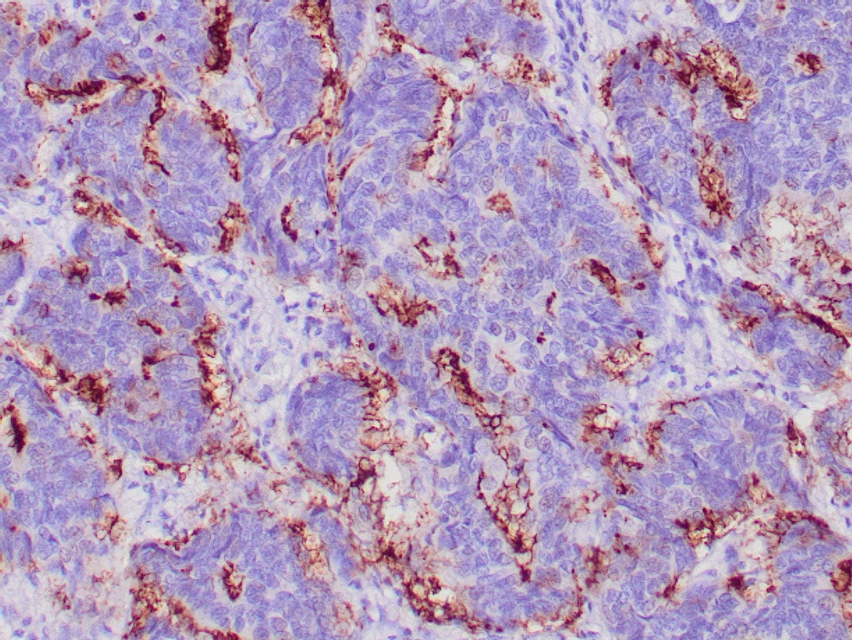 Human breast adenocarcinoma stained with anti-BCA-255 antibody using peroxidase-conjugate and DAB chromogen. Note the cytoplasmic staining of tumor cells.