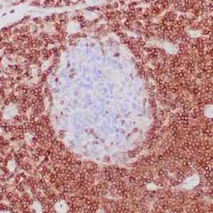Immunohistochemistry (IHC) : Formalin-fixed, paraffin-embedded human tonsil stained with anti-bcl-2 antibody using peroxidase-conjugate and DAB chromogen. Note cytoplasmic and membrane staining of mantle B-cells cells and perifollicular T-cells and no staining of reactive B-cells in the germinal centers