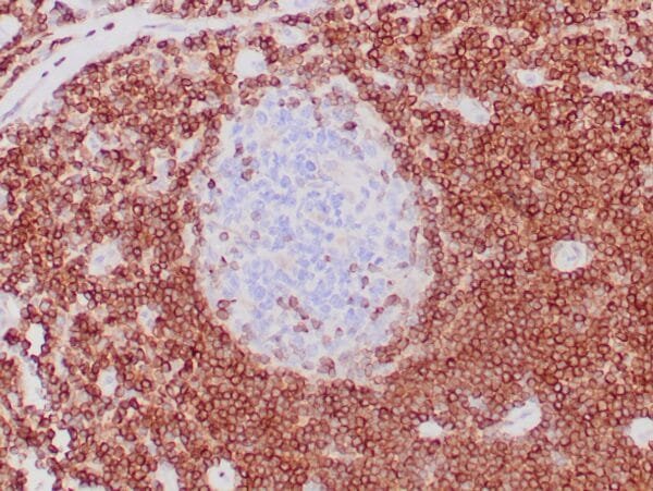 Immunohistochemistry (IHC) : Formalin-fixed, paraffin-embedded human tonsil stained with anti-bcl-2 antibody using peroxidase-conjugate and DAB chromogen. Note cytoplasmic and membrane staining of mantle B-cells cells and perifollicular T-cells and no staining of reactive B-cells in the germinal centers