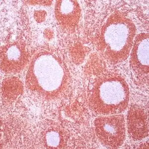 Immunohistochemistry (IHC) : Human reactive lymph node stained with anti-BCL-2 antibody using peroxidase-conjugate and DAB chromogen. Note cytoplasmic and membrane staining of mantle B-cells  and perifollicular T-cells, and no staining of reactive B-cells in the germinal centers.