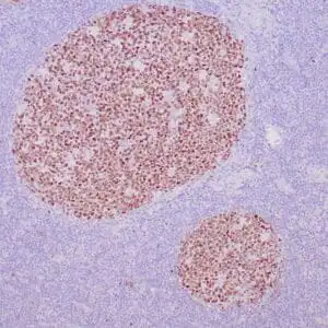 Immunohistochemistry (IHC) : Human reactive lymph node stained with anti-BCL-6 antibody using peroxidase-conjugate and DAB chromogen. Note nuclear staining of follicular center B-cells.