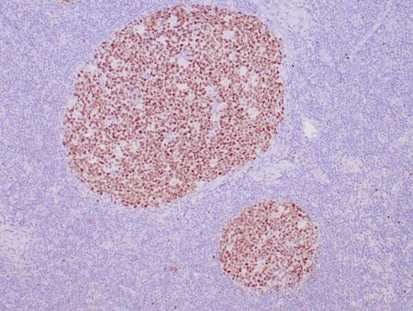 Immunohistochemistry (IHC) : Human reactive lymph node stained with anti-BCL-6 antibody using peroxidase-conjugate and DAB chromogen. Note nuclear staining of follicular center B-cells.