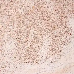 Immunohistochemistry (IHC) : Human small blue round cell sarcoma stained with anti-BCOR antibody using peroxidase-conjugate and DAB chromogen.  Note the nuclear staining of tumor cells.