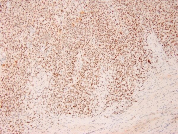 Immunohistochemistry (IHC) : Human small blue round cell sarcoma stained with anti-BCOR antibody using peroxidase-conjugate and DAB chromogen.  Note the nuclear staining of tumor cells.