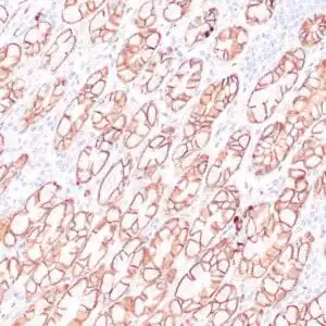 Immunohistochemistry (IHC) : Human colon adenocarcinoma stained with anti-beta-catenin antibody using peroxidase-conjugate and DAB chromogen. Note membranous staining of tumor cells.