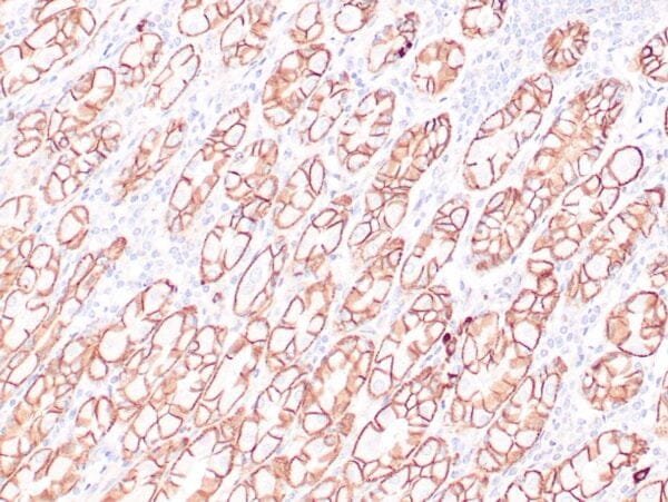 Immunohistochemistry (IHC) : Human colon adenocarcinoma stained with anti-beta-catenin antibody using peroxidase-conjugate and DAB chromogen. Note membranous staining of tumor cells.