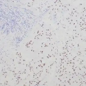 Immunohistochemistry (IHC) : Formalin-fixed and paraffin-embedded human chordoma stained with anti-brachyury antibody using peroxidase-conjugate and DAB chromogen. Note the absence of nuclear staining of tumor cells.
