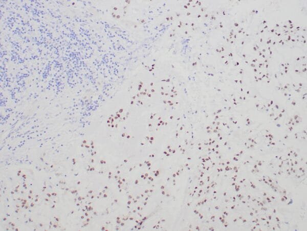 Immunohistochemistry (IHC) : Formalin-fixed and paraffin-embedded human chordoma stained with anti-brachyury antibody using peroxidase-conjugate and DAB chromogen. Note the absence of nuclear staining of tumor cells.