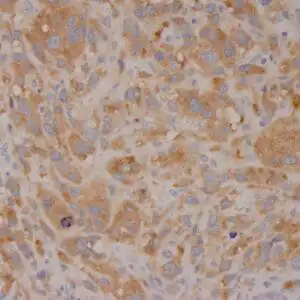 Immunohistochemistry (IHC) : Formalin-fixed, paraffin-embedded human melanoma stained with anti-BRAF (V600E) antibody using peroxidase-conjugate and DAB chromogen. Note cytoplasmic staining of tumor cells with V600E mutation