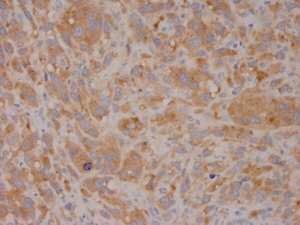 Immunohistochemistry (IHC) : Formalin-fixed, paraffin-embedded human melanoma stained with anti-BRAF (V600E) antibody using peroxidase-conjugate and DAB chromogen. Note cytoplasmic staining of tumor cells with V600E mutation