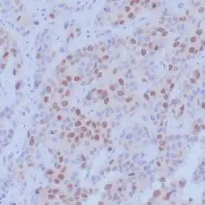 Immunohistochemistry (IHC) : Formalin-fixed, paraffin-embedded human breast carcinoma stained with anti-BRCA-1 antibody using peroxidase-conjugate and DAB chromogen. Note nuclear staining of carcinoma cells.