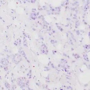 Immunohistochemistry (IHC) : Human breast carcinoma stained with anti-BRCA-1 antibody using peroxidase-conjugate and DAB chromogen. Note nuclear staining of some breast carcinoma cells.
