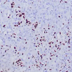 Immunohistochemistry (IHC) : Formalin-fixed and paraffin-embedded human ovarian small cell carcinoma stained with anti-ERG1 antibody using peroxidase-conjugate and DAB chromogen. Note the absence of nuclear staining of tumor cells were retained nuclear staining of background inflammatory cells and endothelial cells