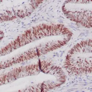 Immunohistochemistry (IHC) : Formalin-fixed, paraffin-embedded human colon adenocarcinoma stained with anti-c-myc antibody using peroxidase-conjugate and DAB chromogen. Note the nuclear staining of tumor cells.