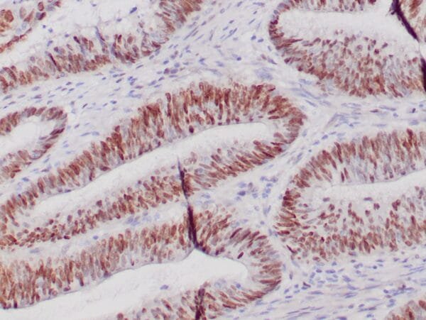 Immunohistochemistry (IHC) : Formalin-fixed, paraffin-embedded human colon adenocarcinoma stained with anti-c-myc antibody using peroxidase-conjugate and DAB chromogen. Note the nuclear staining of tumor cells.