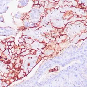 Immunohistochemistry (IHC) : Human ovarian carcinoma stained with anti-CA125 antibody using peroxidase-conjugate and DAB chromogen. Note cell membrane staining of tumor cells.
