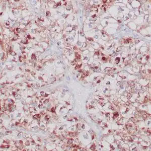Immunohistochemistry (IHC) : Normal human renal tissue stained with anti-CA IX antibody using peroxidase-conjugate and DAB chromogen. Note the membranous staining of tubular cells.