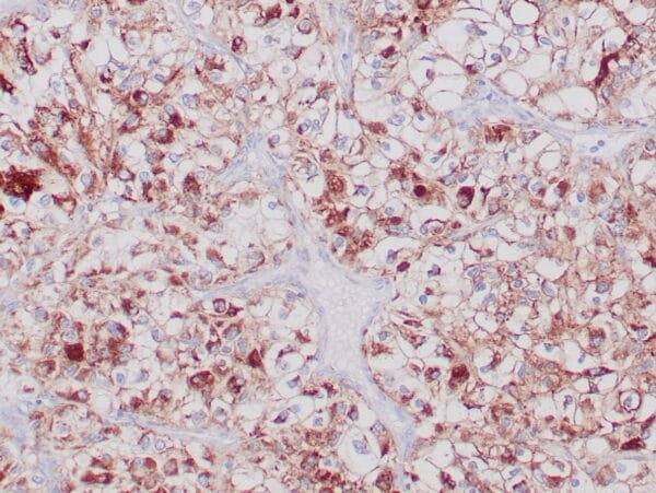 Immunohistochemistry (IHC) : Normal human renal tissue stained with anti-CA IX antibody using peroxidase-conjugate and DAB chromogen. Note the membranous staining of tubular cells.