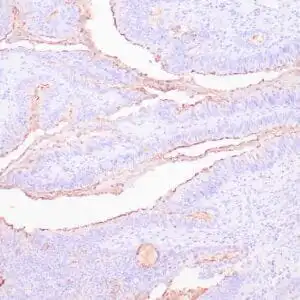 Immunohistochemistry (IHC) : Human colon carcinoma stained with anti-CA19-9 antibody using peroxidase-conjugate and DAB chromogen. Note cytoplasmic staining of tumor cells.